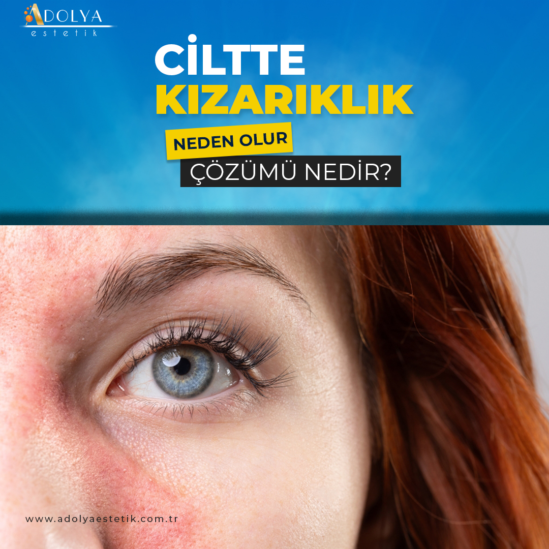 Ciltte Kızarıklık 